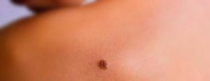 skin tag removal services
